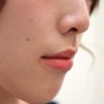 大阪でほくろ除去が安いおすすめクリニック16選|取り放題の対応院や梅田・難波・道頓堀で評判のいいクリニックを厳選