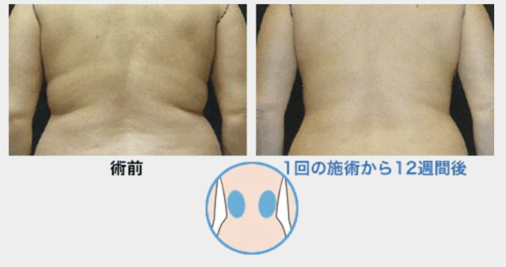 湘南美容クリニック クールスカルプティング® エリート(クルスカダブル)FLAT125・FLAT165 症例画像