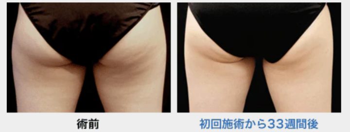 湘南美容クリニック クールスカルプティング® エリート(クルスカダブル)CURVE240 症例画像