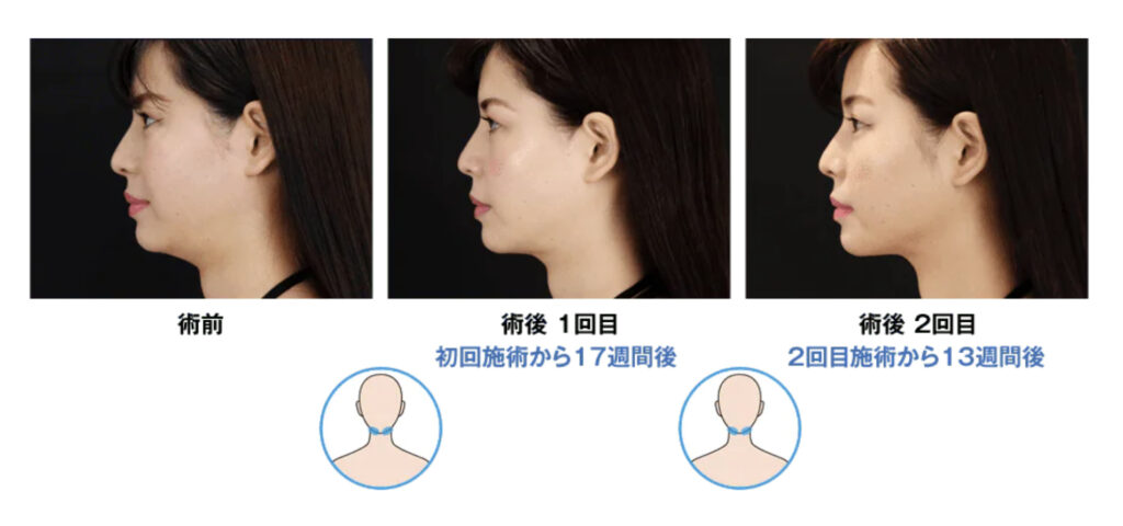 湘南美容クリニック クールスカルプティング® エリート(クルスカダブル)CURVE80 症例画像