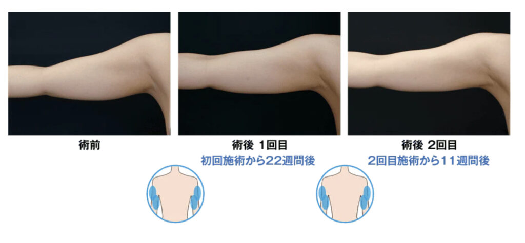 湘南美容クリニック クールスカルプティング® エリート(クルスカダブル)CURVE120・CURVE150 症例画像