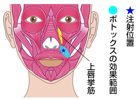 TCB東京中央美容外科　ガミースマイル