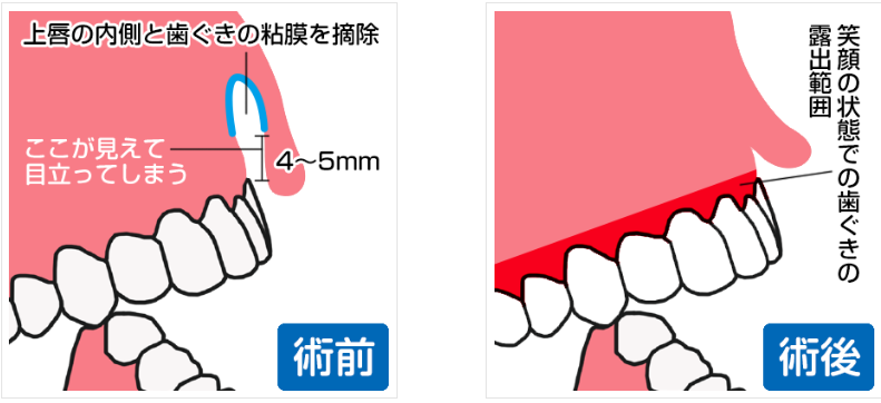 TCB東京中央美容外科　ガミースマイル