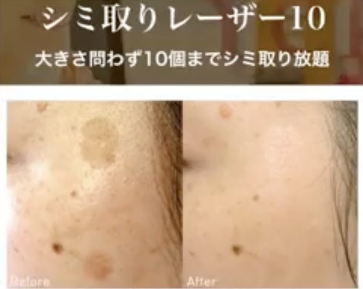 湘南美容 シミ取りレーザー10