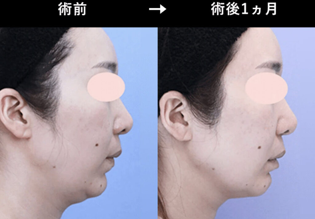 湘南美容クリニック ハイフ 症例画像