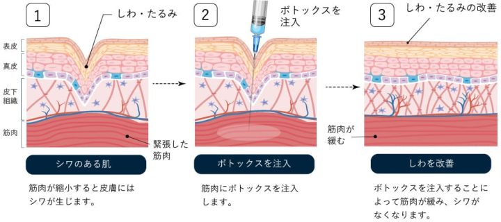 TCB東京中央美容外科　ボトックス