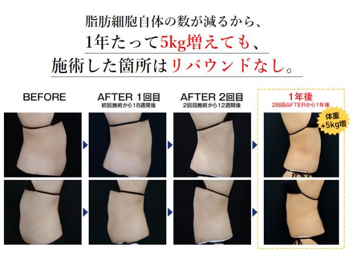湘南美容クリニック クールスカルプティング® エリート(クルスカダブル) 症例画像