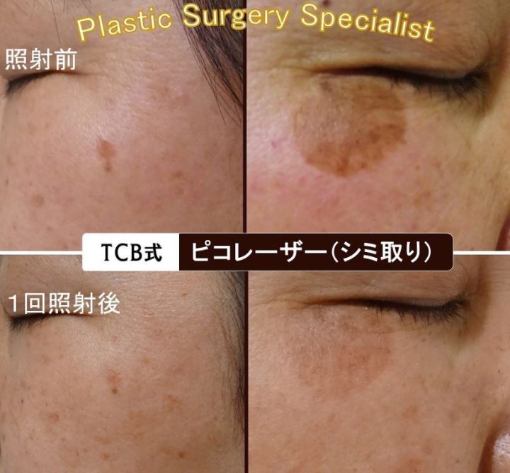 TCB東京中央美容外科 ピコレーザー(シミ取り) 症例画像