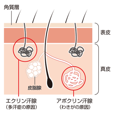 TCB東京中央美容外科 多汗症ボトックス
