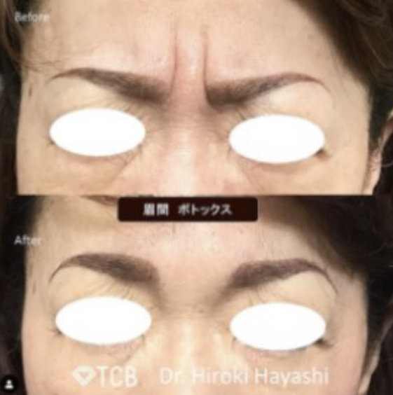 TCB東京中央美容外科 眉間ボトックス