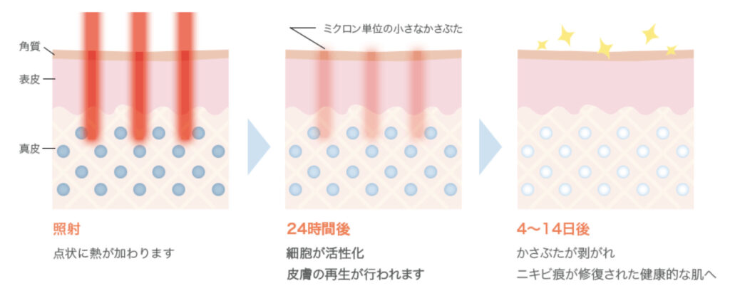 美容皮膚科ローズマリークリニック フラクショナルレーザー ニキビ跡(クレーター)の改善効果
