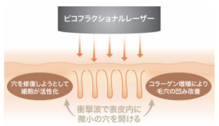 ユイメディカルクリニック ピコフラクショナルレーザー 毛穴開き改善と悪化防止効果