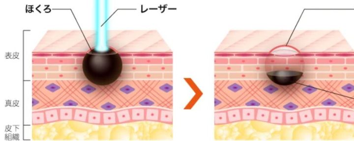 TCB東京中央美容外科（TCB東京中央美容外科） ほくろ除去 炭酸ガスレーザーでのほくろ除去