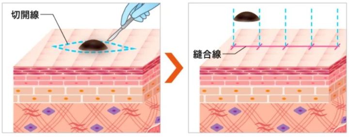TCB東京中央美容外科（TCB東京中央美容外科） ほくろ除去 切開でのほくろ除去