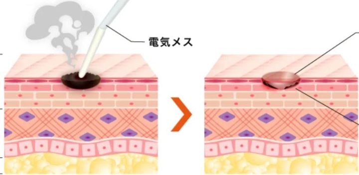 TCB東京中央美容外科（TCB東京中央美容外科） ほくろ除去 電気メスでのほくろ除去
