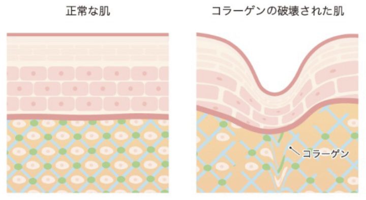 皮膚の弾力成分の減少 銀座たるみクリニック 引用画像