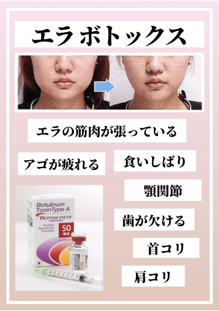 aralaクリニック エラボトックス