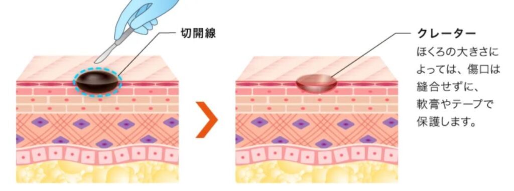 ほくろ除去は皮膚科と美容外科どっち?