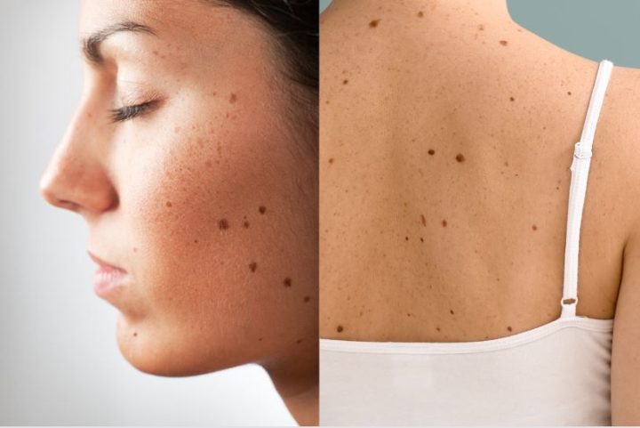 ほくろ除去は皮膚科と美容外科どっち?