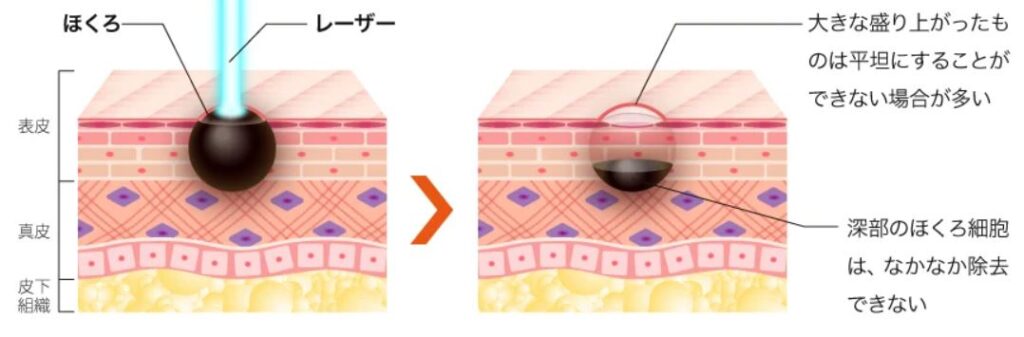 ほくろ除去は皮膚科と美容外科どっち?