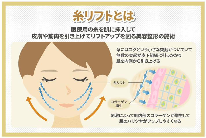 共立美容外科 糸リフト