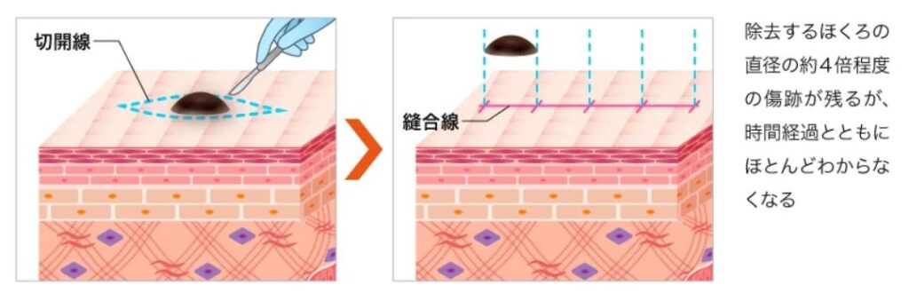 ほくろ除去は皮膚科と美容外科どっち?