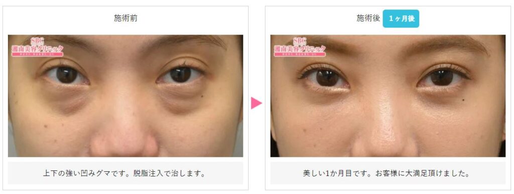 湘南美容クリニック 目の下の切らないたるみ取り