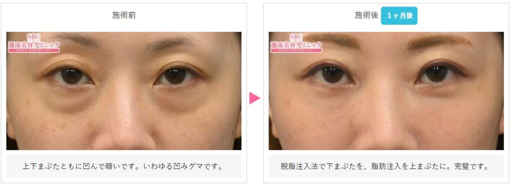 湘南美容クリニック 目の下の切らないたるみ取り