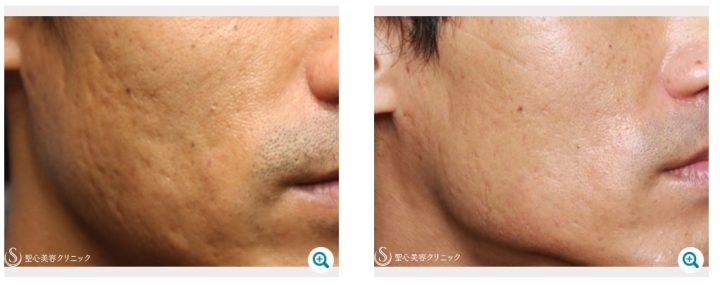 聖心美容クリニック六本木院　ポテンツァ症例