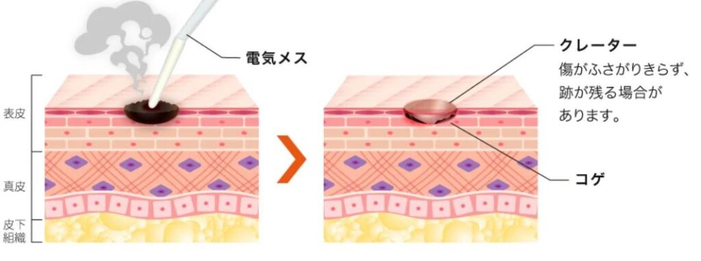 ほくろ除去は皮膚科と美容外科どっち?