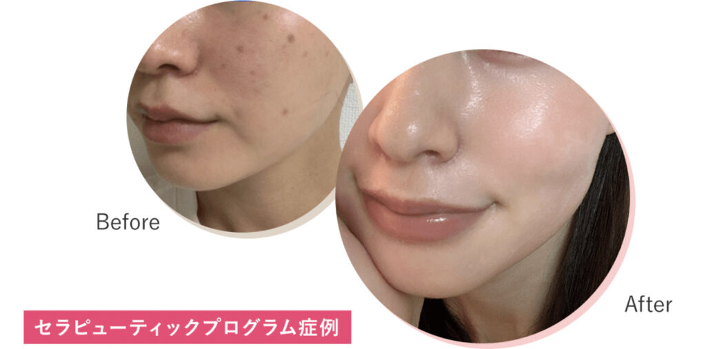 クリニックフォア ゼオスキン 口コミ