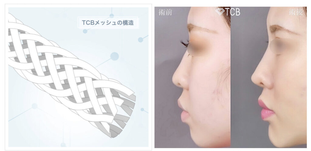 TCBメッシュ 口コミ
