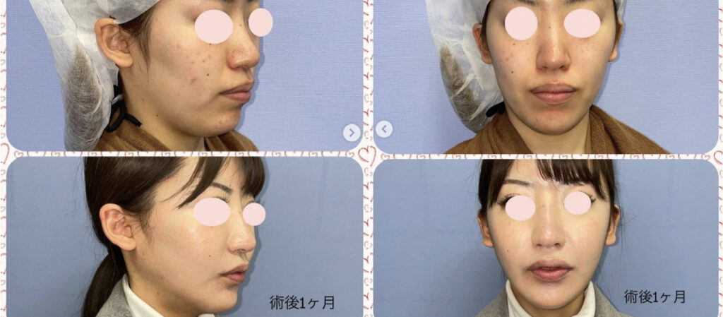 湘南美容クリニック　骨切り　口コミ