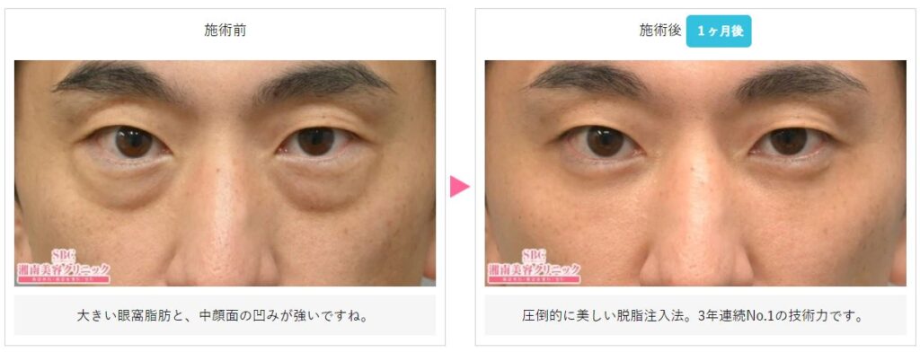 湘南美容クリニック 目の下の切らないたるみ取り
