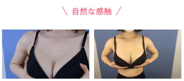 湘南美容クリニック コンデンスリッチ脂肪注入豊胸