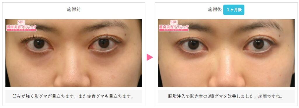 湘南美容クリニック 目の下の切らないたるみ取り