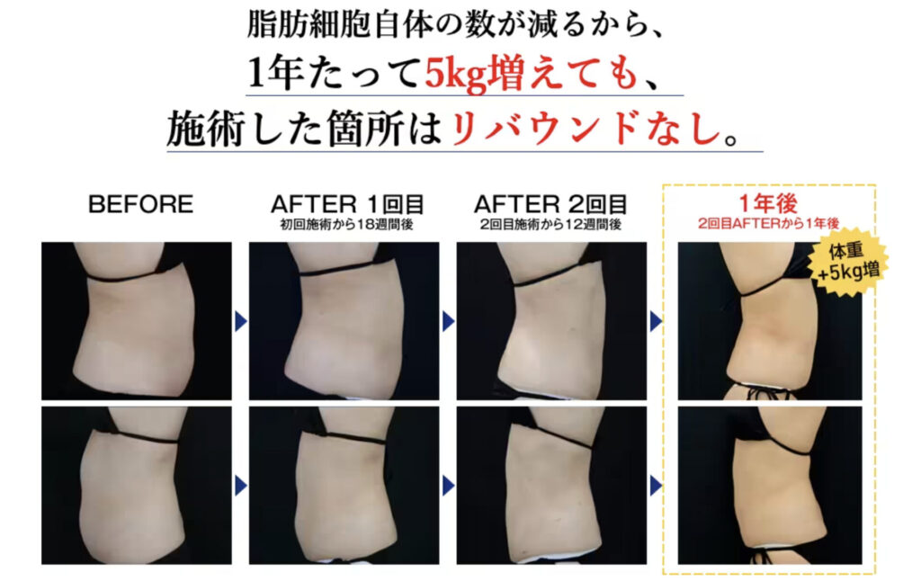 脂肪吸引 人生変わった