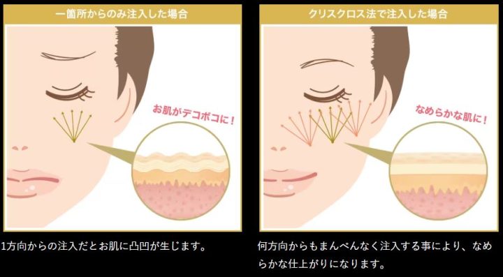 湘南美容クリニック ナノリッチ クリスクロス法
