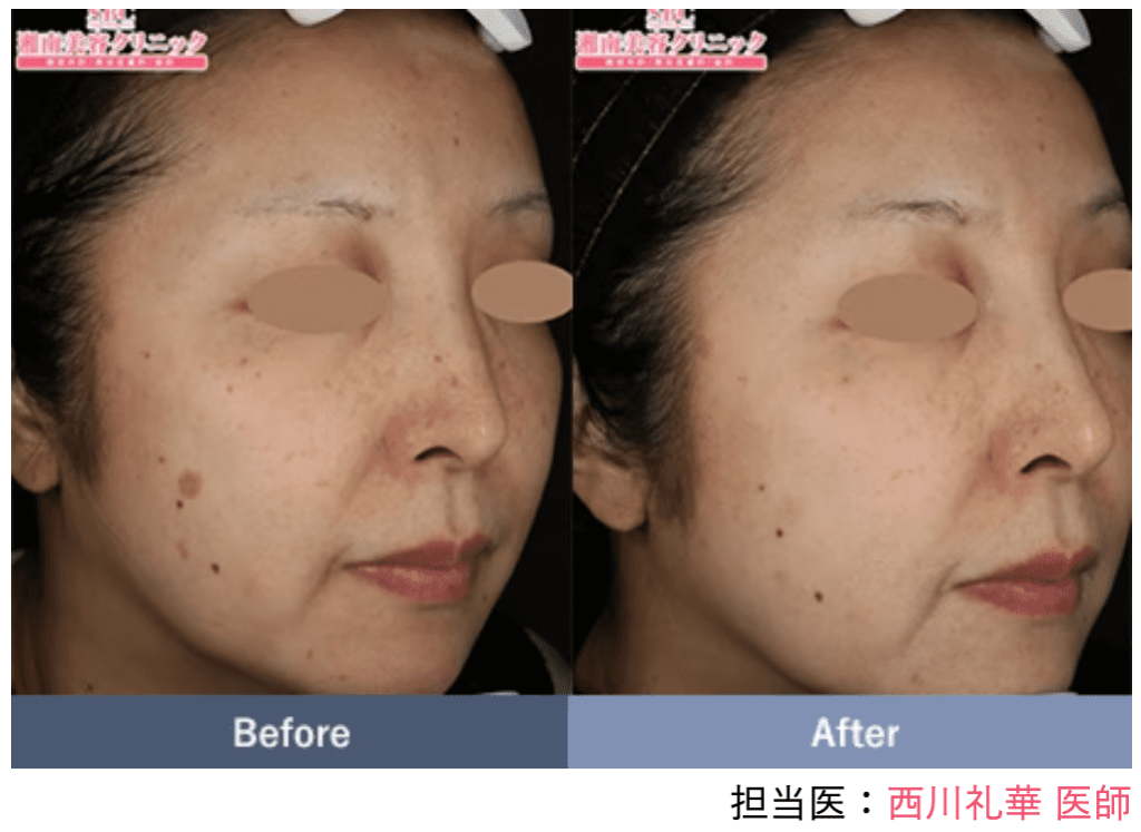 湘南美容クリニック シミ取り