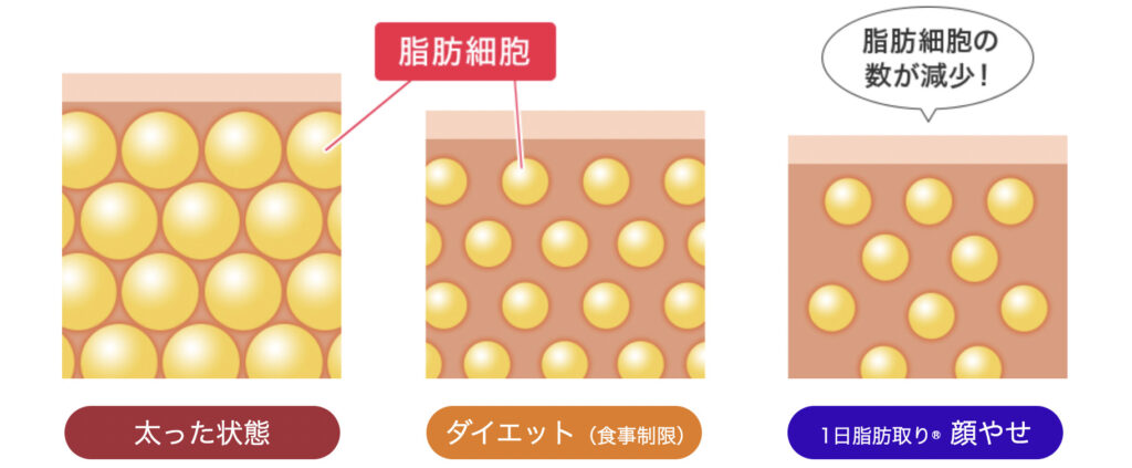 脂肪吸引 人生変わった
