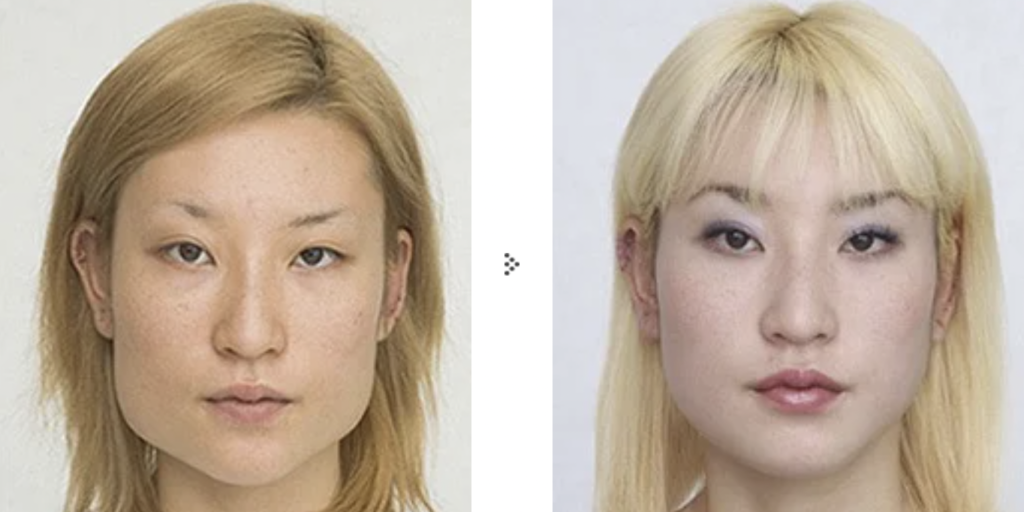 共立美容外科 エラ削り