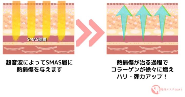 ハイフの仕組み