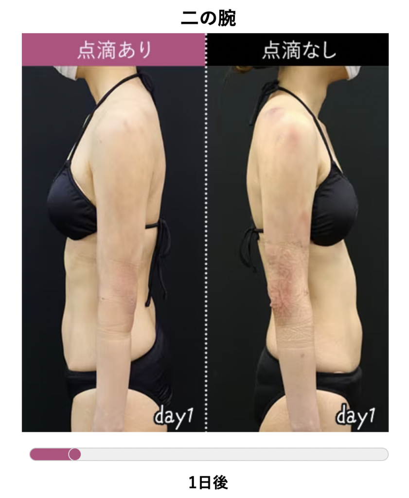 二の腕 脂肪吸引