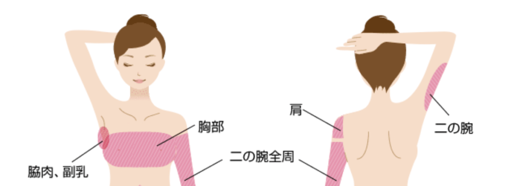 二の腕 脂肪吸引