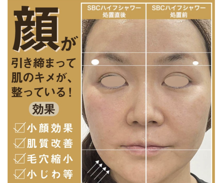 ハイフシャワー 効果