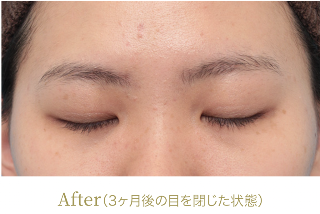 高須 クリニック 埋没 口コミ