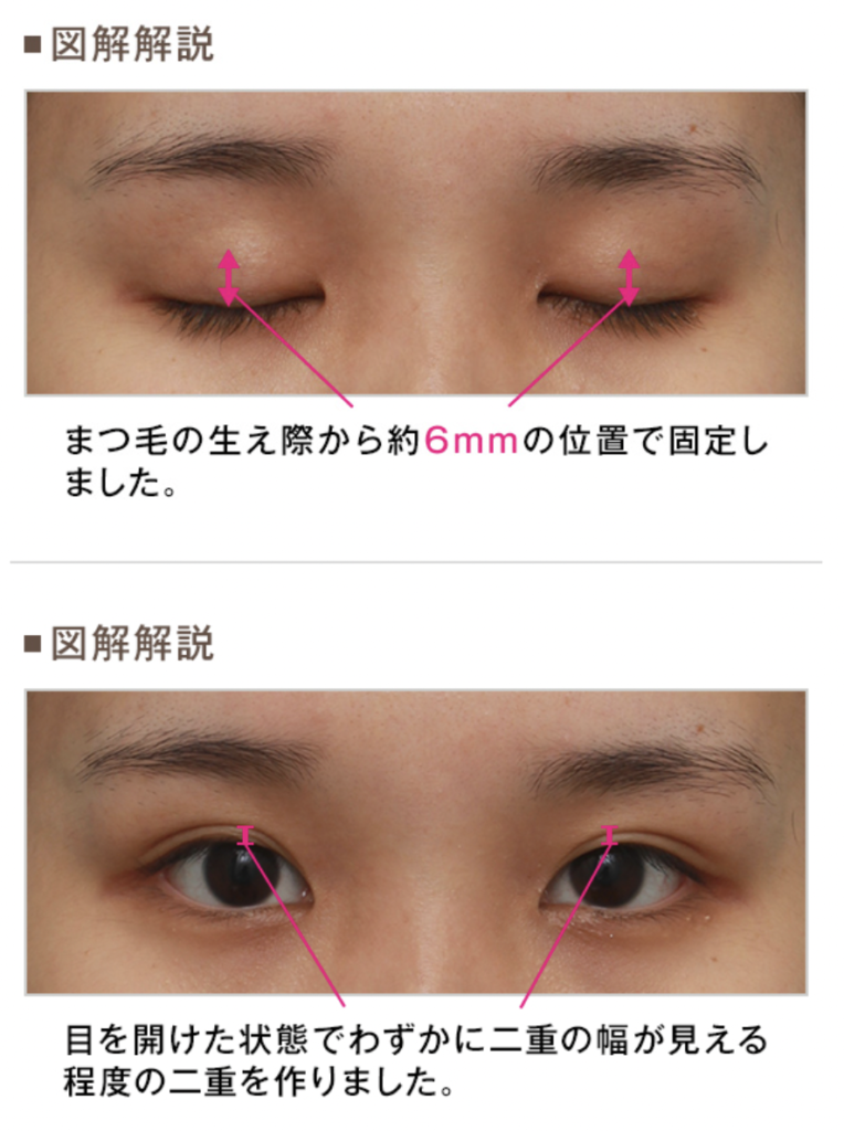 高須 クリニック 埋没 口コミ