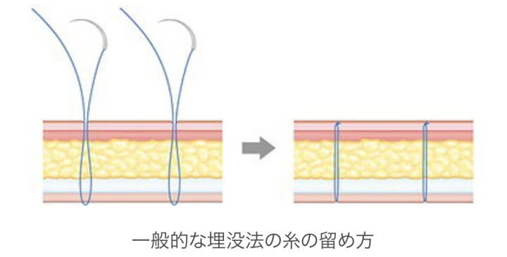 高須 クリニック 埋没 口コミ