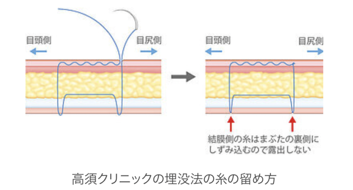 高須 クリニック 埋没 口コミ
