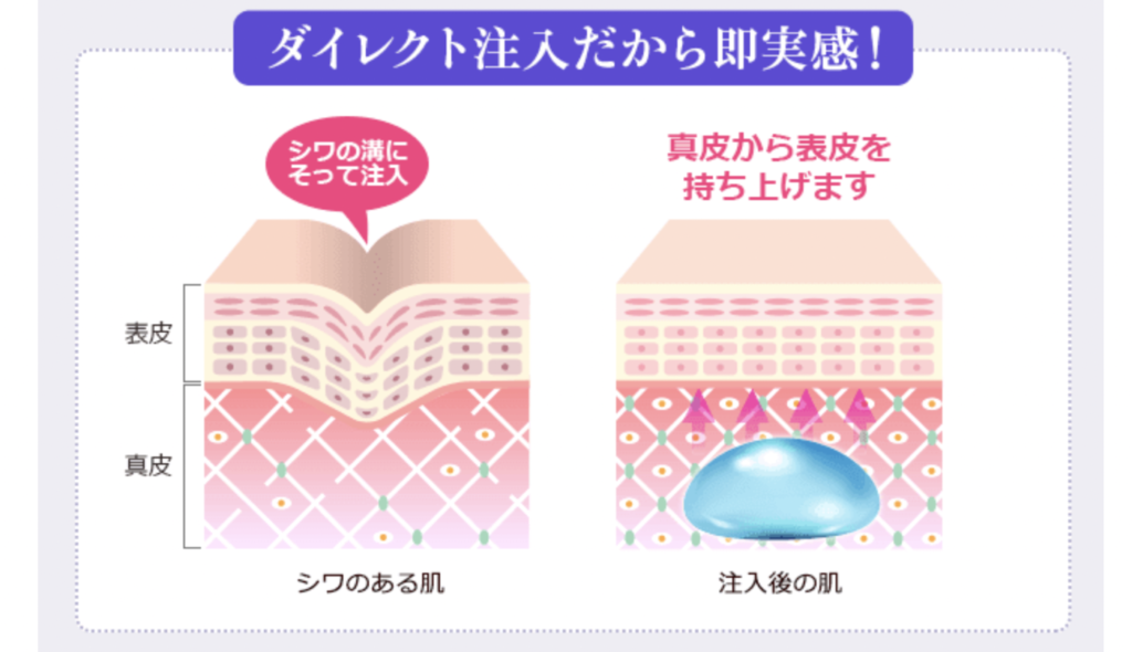 ほうれい線治療 おすすめ